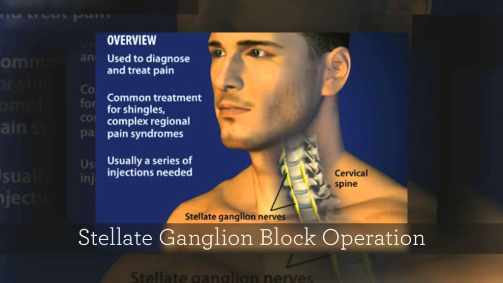 Picture of Stellate ganglion block injection – Total Pain Clinic