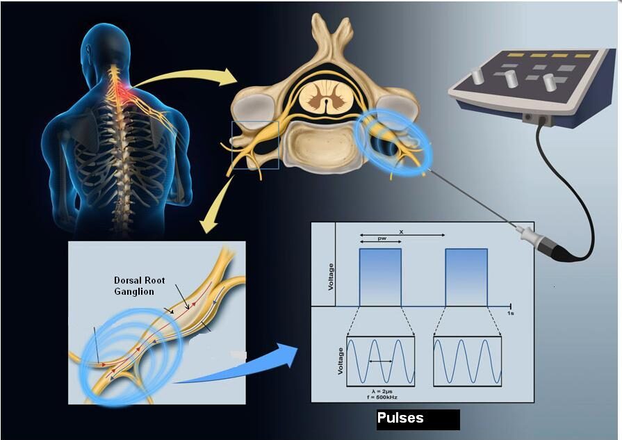 Pulsed Radiofrequency to intercostal nerves Total Pain Clinic